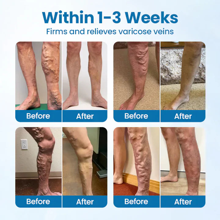 Timilk® VeinGuard Herbal Spray-✅ Clinically proven to eliminate varicose veins in just 7 days!